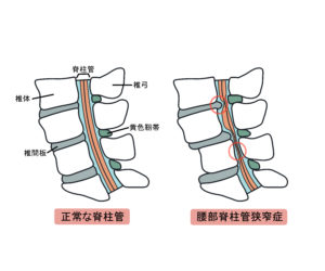 脊柱管狭窄症の解剖図