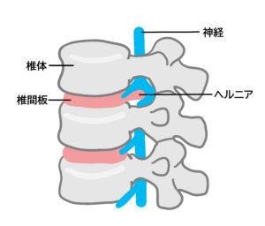 椎間板ヘルニアの解剖図